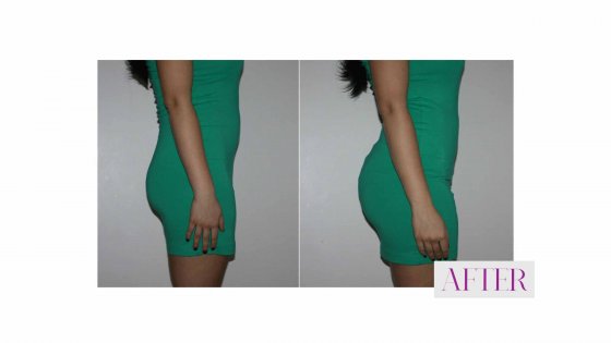 brazilian butt lift amaryllis clinic plastic surgery abu dhabi 1