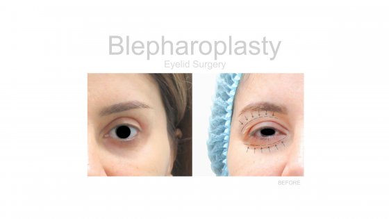 eyelid surgery blepharoplasty amaryllis clinic plastic surgery abu dhabi before and after