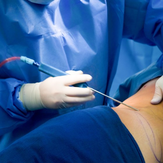 liposuction amaryllis clinic plastic surgery abu dhabi