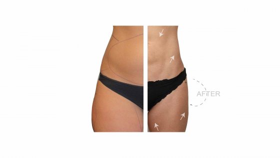 mini liposuction amaryllis clinic plastic surgery abu dhabi 1687424706