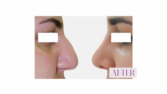 rhinoplasty amaryllis clinic plastic surgery german plastic surgeon in abu dhabi 1