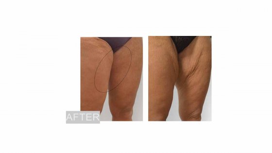 thigh lift amaryllis clinic plastic surgery abu dhabi dr. chris reuter german plastic surgeon before and after