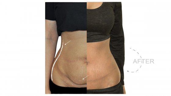 abdominoplasty or tummy tuck amaryllis clinic plastic surgery abu dhabi 2