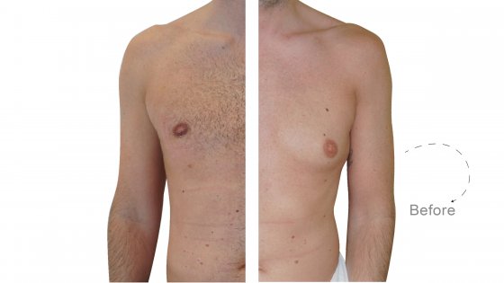 gynecomastia man breast surgery amaryllis clinic plastic surgery abu dhabi befor and after