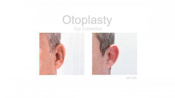 ear correction otoplasty amaryllis clinic plastic surgery best clinic in abu dhabi