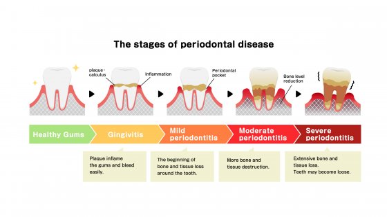 gum and periodontal treatment amaryllis german clinic best dental clinic in abu dhabi 0