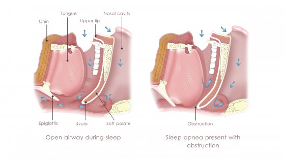 sleep apnea treatment and snoring devices amaryllis german clinic best dental clinic in abu dhabi