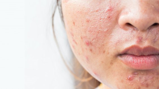 acne treatment amaryllis clinic plastic surgery dr. chris reuter german plastic surgeon in abu dhabi 2