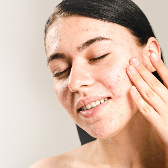 acne scar treatments amaryllis clinic plastic surgery dr. chris reuter german plastic surgeon in abu dhabi