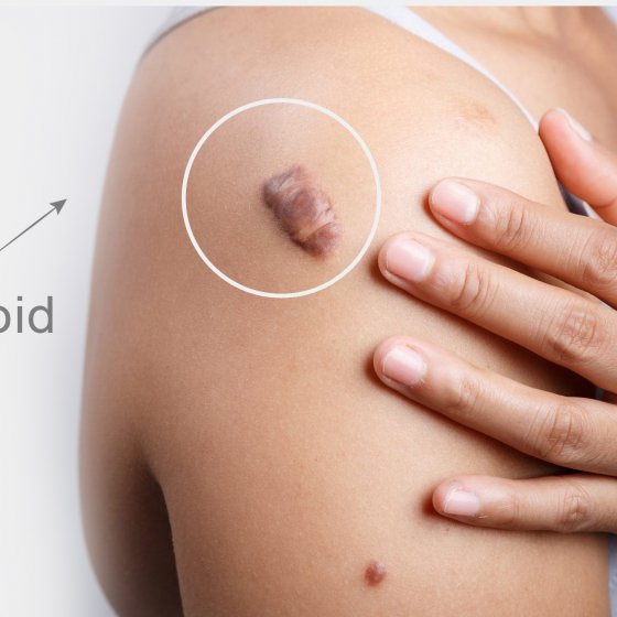 keloid treatment amaryllis clinic plastic surgery dr. chris reuter german plastic surgeon in abu dhabi