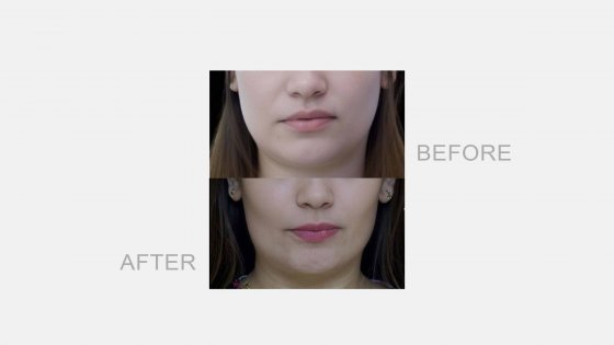 morpheus8 prp treatment amaryllis clinic abu dhabi after