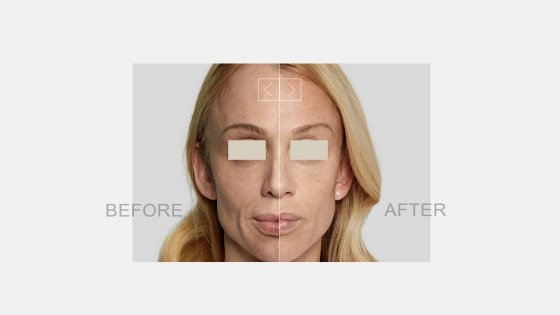 sculptra amaryllis clinic abu dhabi