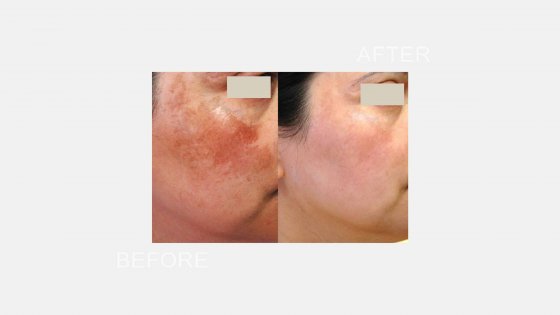 skin pigmentation treatment amaryllis clinic plastic surgery dr. chris reuter german plastic surgeon in abu dhabi 2 1687781903