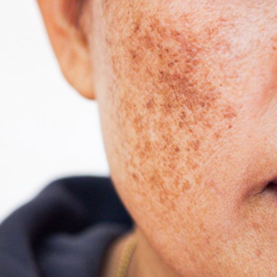 skin pigmentation treatment amaryllis clinic plastic surgery dr. chris reuter german plastic surgeon in abu dhabi