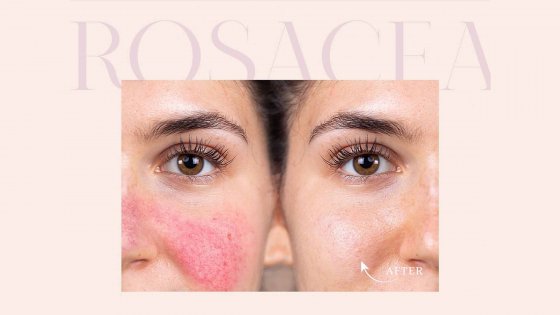rosacea treatment amaryllis clinic plastic surgery dr. chris reuter german plastic surgeon in abu dhabi 1