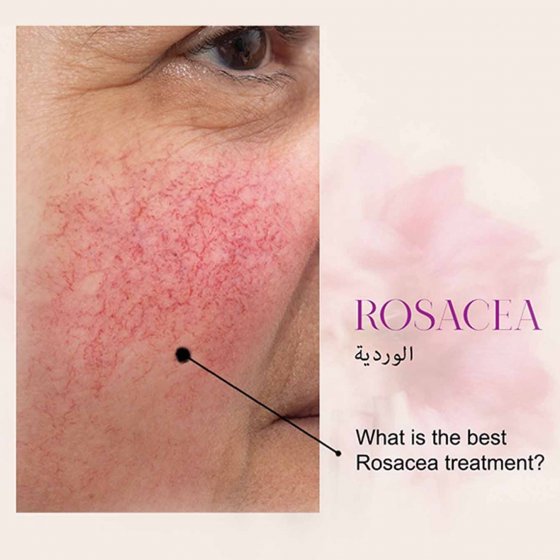 rosacea treatment amaryllis clinic plastic surgery dr. chris reuter german plastic surgeon in abu dhabi